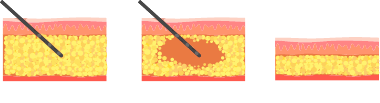 脂肪溶解注射が作用するイメージ図